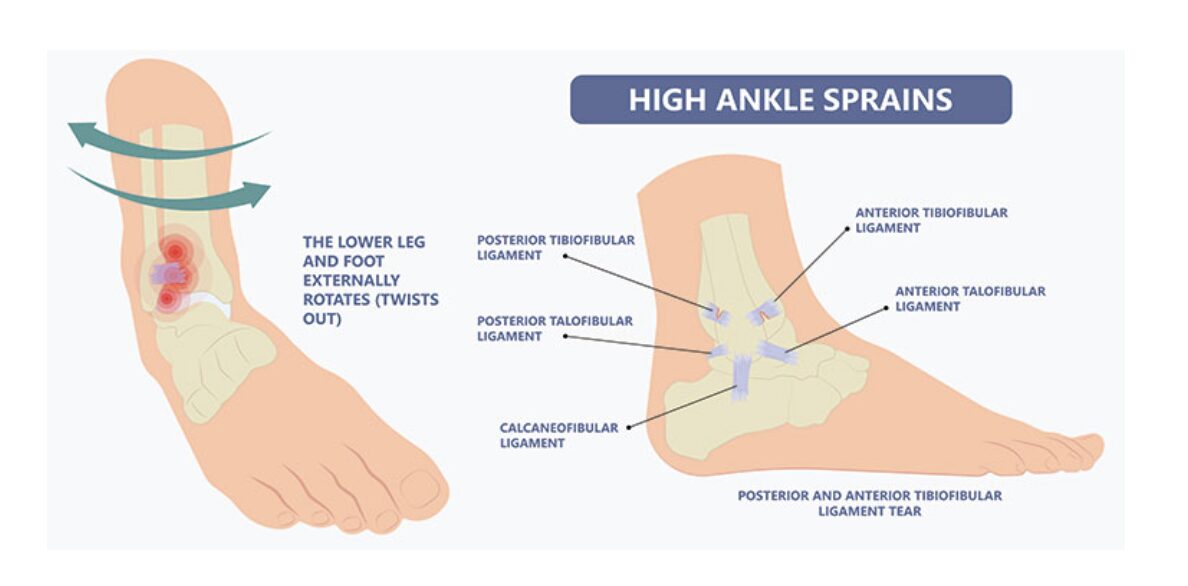 SYNDESMOTIC SPRAINS: HIGH ANKLE SPRAINS 1 Screenshot 2024 11 06 at 9.45.59 AM